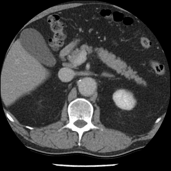 Aortic intramural hematoma (type B) (Radiopaedia 79323-92387 Axial C+ delayed 62).jpg