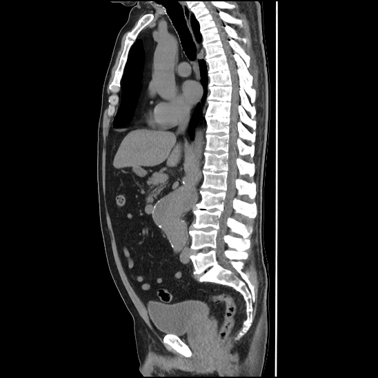 Aortic intramural hematoma (type B) (Radiopaedia 79323-92387 G 24).jpg