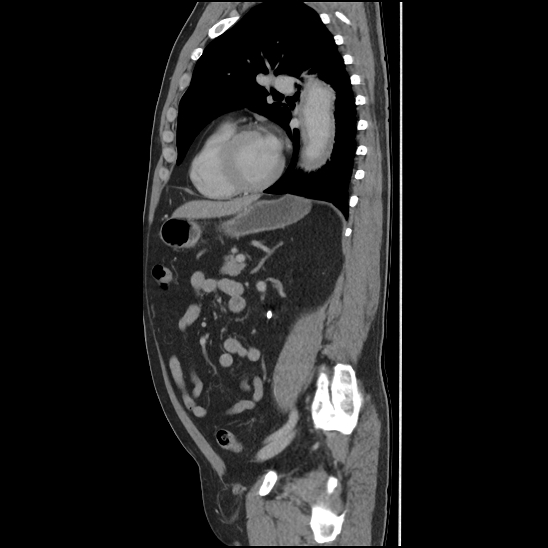Aortic intramural hematoma (type B) (Radiopaedia 79323-92387 Sagittal C+ delayed 35).jpg