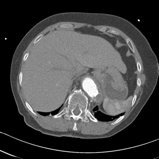 Aortic intramural hematoma from penetrating atherosclerotic ulcer (Radiopaedia 31137-31836 A 70).jpg