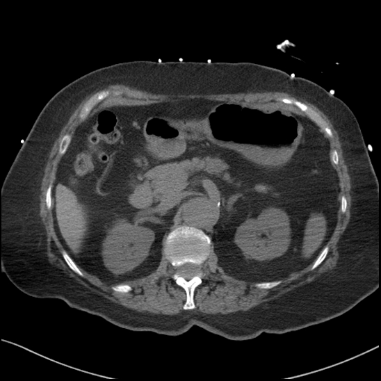 File:Aortic intramural hematoma with dissection and intramural blood pool (Radiopaedia 77373-89491 Axial non-contrast 106).jpg