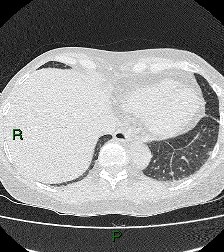 File:Aortic valve endocarditis (Radiopaedia 87209-103485 Axial lung window 81).jpg