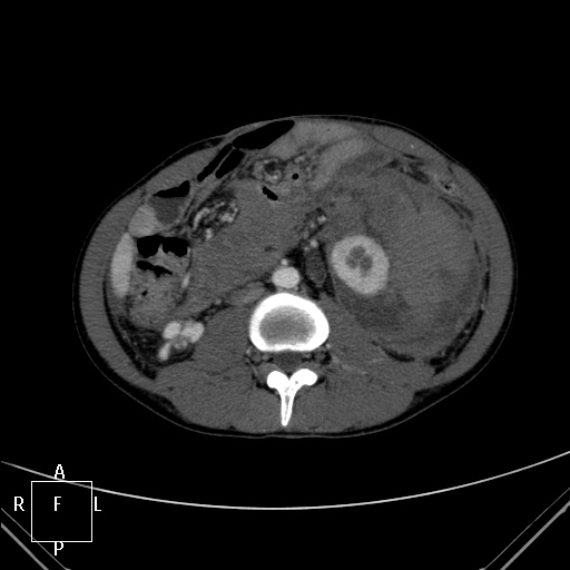 File:Aorto-left renal vein fistula (Radiopaedia 45534-49628 A 36).jpg
