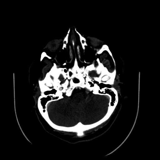 Aplasia of the internal carotid artery (Radiopaedia 61082-68960 A 16).jpg