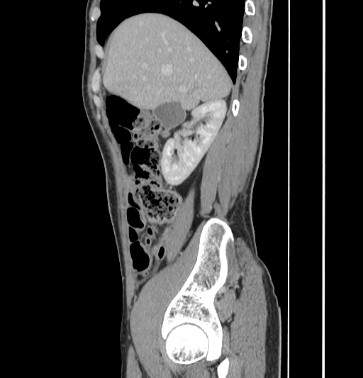 Appendiceal mucinous adenocarcinoma (Radiopaedia 66605-75922 C 17).jpg