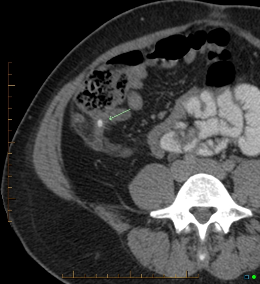 File:Appendicitis post recent cesarian section (Radiopaedia 29594-30102 A 1).jpg