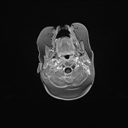 Aqueductal stenosis (Radiopaedia 73974-84802 Axial T1 C+ 26).jpg