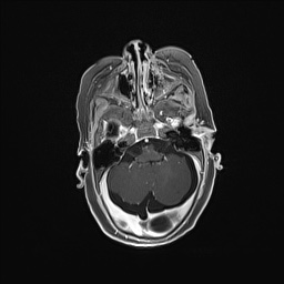 Aqueductal stenosis (Radiopaedia 73974-84802 Axial T1 C+ 51).jpg