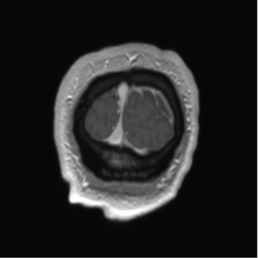 Arachnoid cyst with subdural hematoma (Radiopaedia 85892-101743 Coronal T1 C+ 4).png