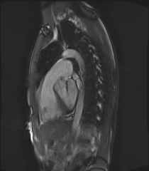 File:Arrhythmogenic right ventricular cardiomyopathy (Radiopaedia 57972-64966 Cine RVOT SSFP 9).jpg