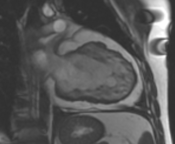 Arrhythmogenic right ventricular cardiomyopathy (Radiopaedia 69431-79307 2ch cine 38).jpg