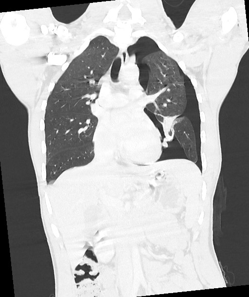 Arrow injury to the chest (Radiopaedia 85367-100975 Coronal lung window 72).jpg