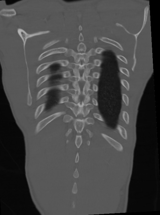 Arrow injury to the neck (Radiopaedia 75225-86323 Coronal bone window 101).jpg