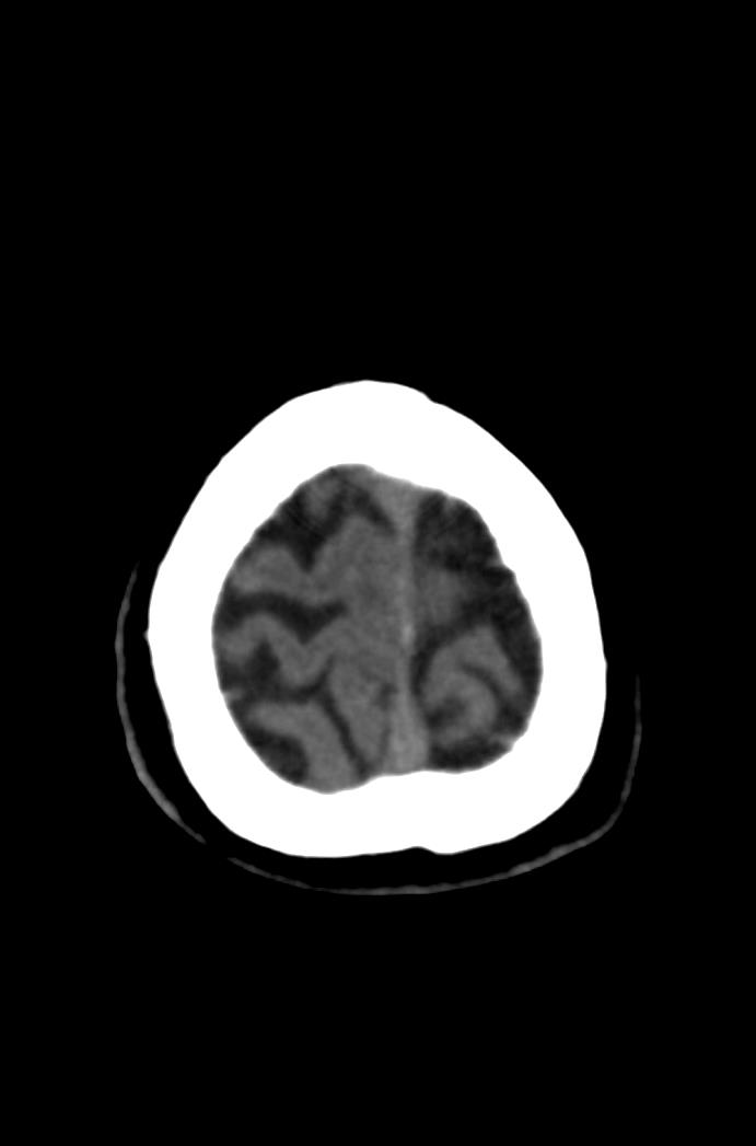 Artery of Percheron infarction (Radiopaedia 80613-94202 Axial non-contrast 176).jpg