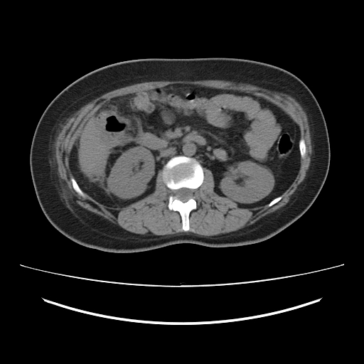 Ascending retrocecal appendicitis with liver abscesses (Radiopaedia 60066-67615 Axial non-contrast 37).jpg