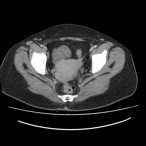 Ascending retrocecal appendicitis with liver abscesses (Radiopaedia 60066-67615 B 81).jpg