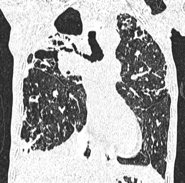 Aspergilloma- with Monod sign (Radiopaedia 44737-48532 Coronal lung window 238).jpg