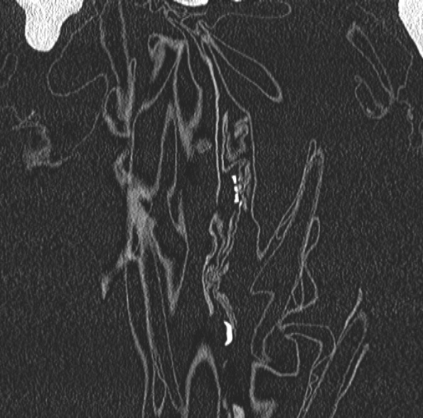 Aspergilloma- with Monod sign (Radiopaedia 44737-48532 Coronal lung window 79).jpg
