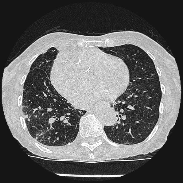 Aspergilloma (Radiopaedia 24458-24763 Axial lung window 44).jpg