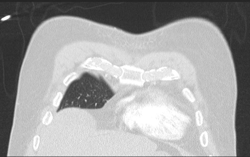 Aspirated tooth (Radiopaedia 28584-28844 Axial lung window 29).jpg