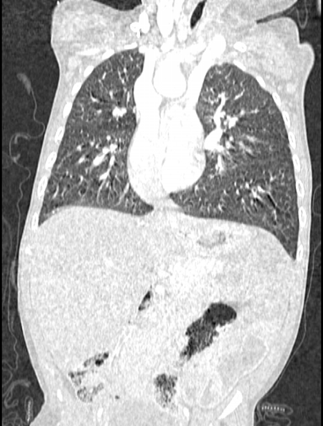 Asplenia syndrome (Radiopaedia 73083-83792 Coronal lung window 68).jpg