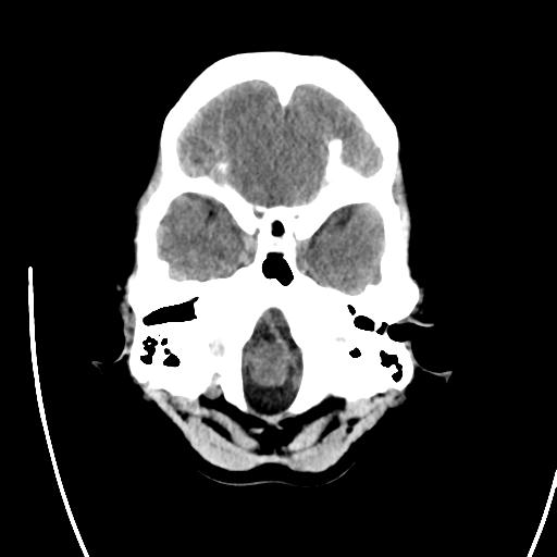 File:Atretic encephalocoele with inferior vermis hypoplasia (Radiopaedia 30443-31107 A 5).jpg
