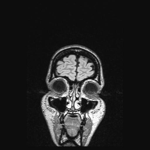 Atretic encephalocoele with inferior vermis hypoplasia (Radiopaedia 30443-31108 Coronal FLAIR 164).jpg