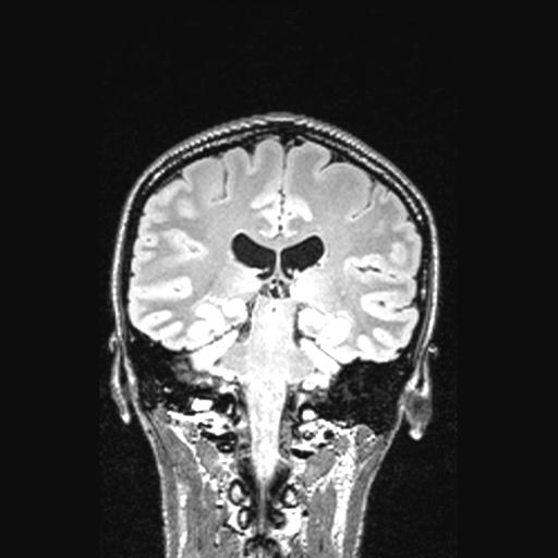 Atretic encephalocoele with inferior vermis hypoplasia (Radiopaedia 30443-31108 Coronal FLAIR 78).jpg