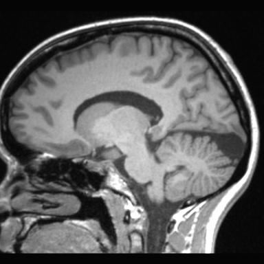 Atretic encephalocoele with inferior vermis hypoplasia (Radiopaedia 30443-31108 Sagittal T1 76).jpg