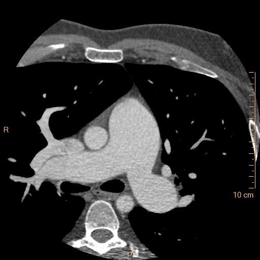 Atrial septal defect (upper sinus venosus type) with partial anomalous pulmonary venous return into superior vena cava (Radiopaedia 73228-83961 A 57).jpg