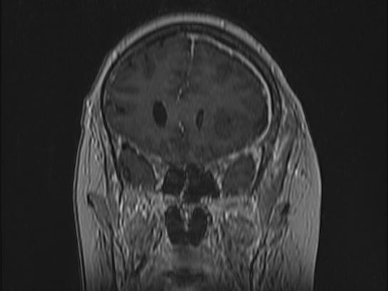 Atypical meningioma (Radiopaedia 62985-71406 Coronal T1 C+ 33).jpg