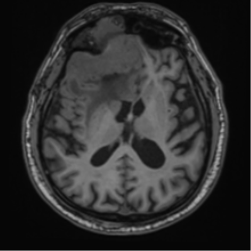 File:Atypical meningioma (WHO grade II) with brain invasion (Radiopaedia 57767-64729 Axial T1 27).png