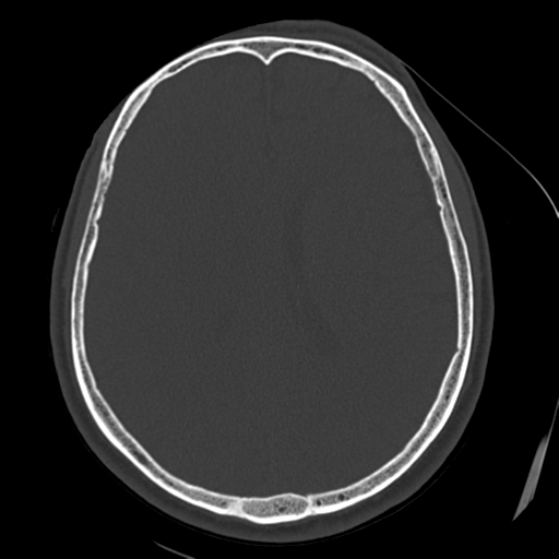 File:Atypical meningioma (WHO grade II) with osseous invasion (Radiopaedia 53654-59715 Axial bone window 49).png
