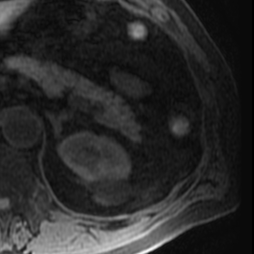 File:Atypical renal cyst on MRI (Radiopaedia 17349-17046 Axial T1 fat sat 7).jpg