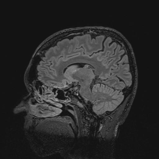 Autoimmune limbic encephalitis (Radiopaedia 30363-31005 Sagittal FLAIR 71).jpg