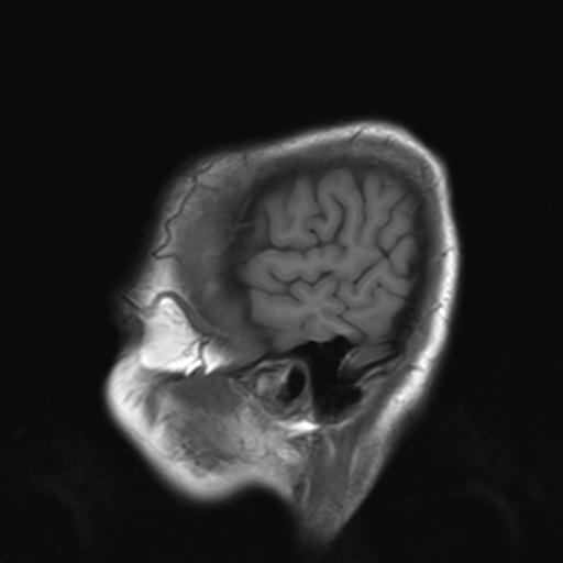 File:Autoimmune limbic encephalitis (Radiopaedia 30363-31005 Sagittal T1 2).jpg