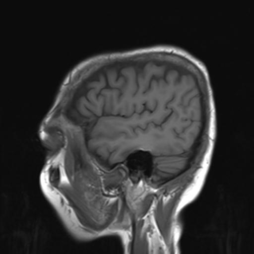 File:Autoimmune limbic encephalitis (Radiopaedia 30363-31005 Sagittal T1 4).jpg