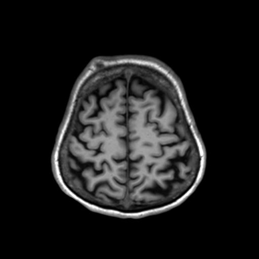 Autoimmune limbic encephalitis (Radiopaedia 30363-31005 T1 Axial 3mm 41).jpg