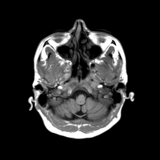 Autoimmune limbic encephalitis (Radiopaedia 30363-31005 T1 Axial 3mm 9).jpg