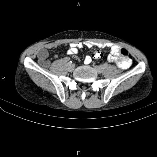 Autoimmune pancreatitis (Radiopaedia 84925-100431 Axial C+ delayed 63).jpg