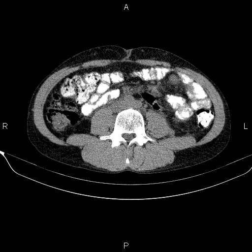 File:Autoimmune pancreatitis (Radiopaedia 84925-100431 Axial non-contrast 32).jpg
