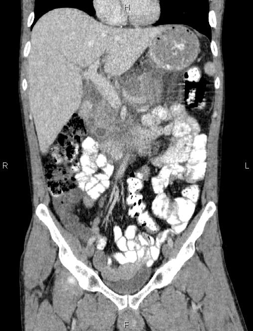 Autoimmune pancreatitis (Radiopaedia 84925-100431 D 24).jpg