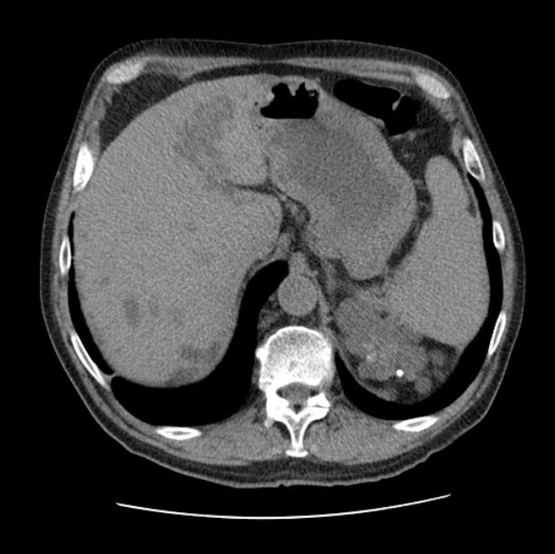 Autosomal dominant polycystic kidney disease (Radiopaedia 27851-28094 Axial non-contrast 52).jpg