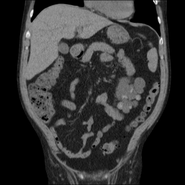 File:Autosomal dominant polycystic kidney disease (Radiopaedia 36539-38101 C 25).jpg
