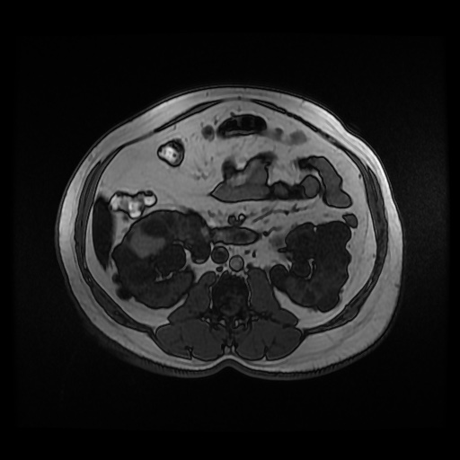 Autosomal dominant polycystic kidney disease (Radiopaedia 50259-55611 Axial 2D Dual Echo 49).jpg
