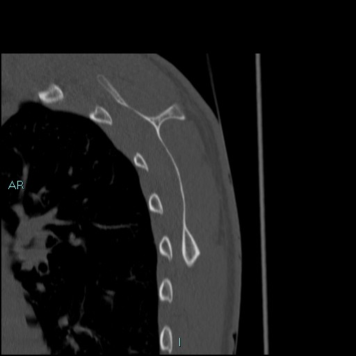 Avascular necrosis after fracture dislocations of the proximal humerus (Radiopaedia 88078-104653 Sagittal bone window 70).jpg