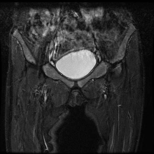 File:Avascular necrosis of the hip (Radiopaedia 29563-30067 Coronal T2 fat sat 2).jpg