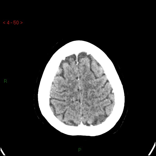 Azygos anterior cerebral artery (Radiopaedia 51987-57833 A 50).jpg