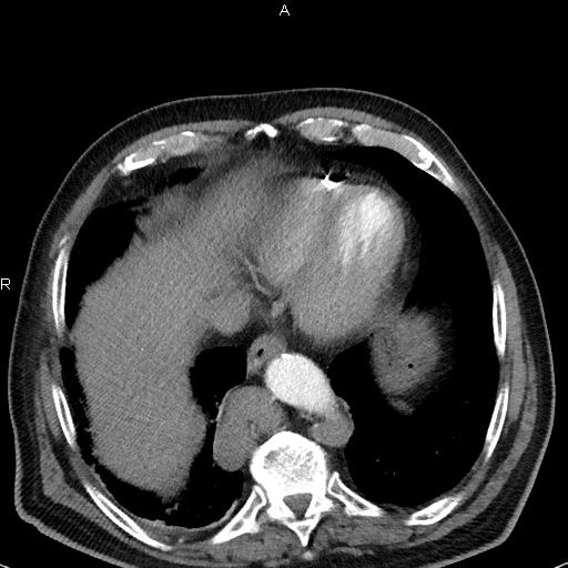 File:Azygos continuation of the inferior vena cava (Radiopaedia 18537-18404 C+ arterial phase 43).jpg