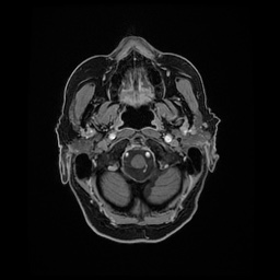 Balo concentric sclerosis (Radiopaedia 53875-59982 Axial LAVA C+ 28).jpg